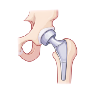Total Hip Replacement Surgery in Firozabad by Dr. Parv Mittal