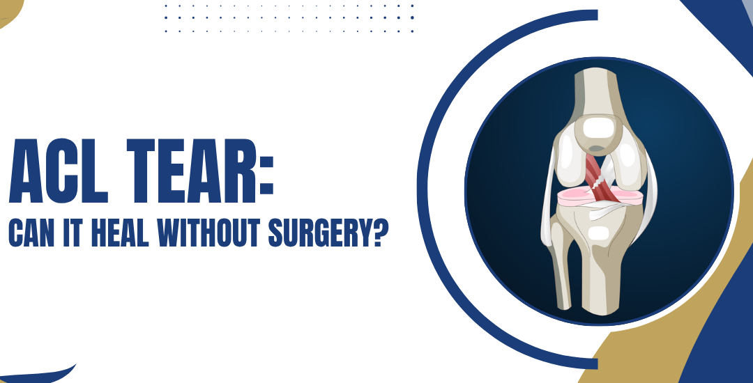 ACL Tear: Can It Heal Without Surgery?