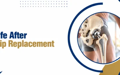 Life After Hip Replacement: Recovery Timeline and What to Expect in the First 3 Months